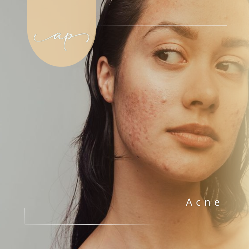 Acné