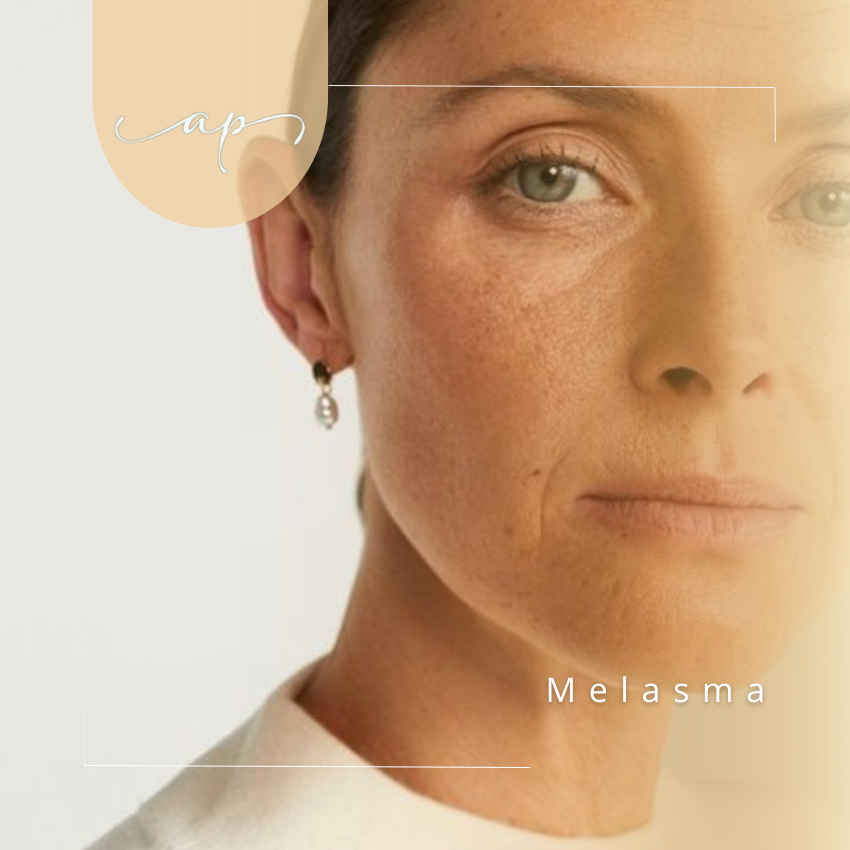 Melasma