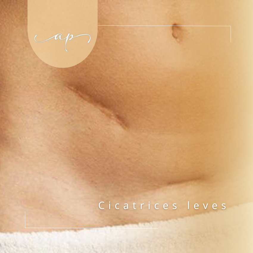 Cicatrices leves