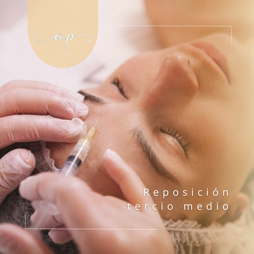 Reposición de tercio medio