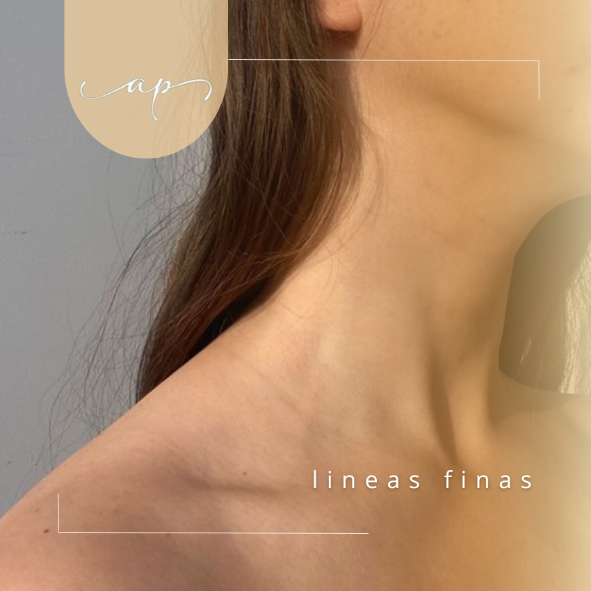 Líneas finas/arrugas en cuello y escote