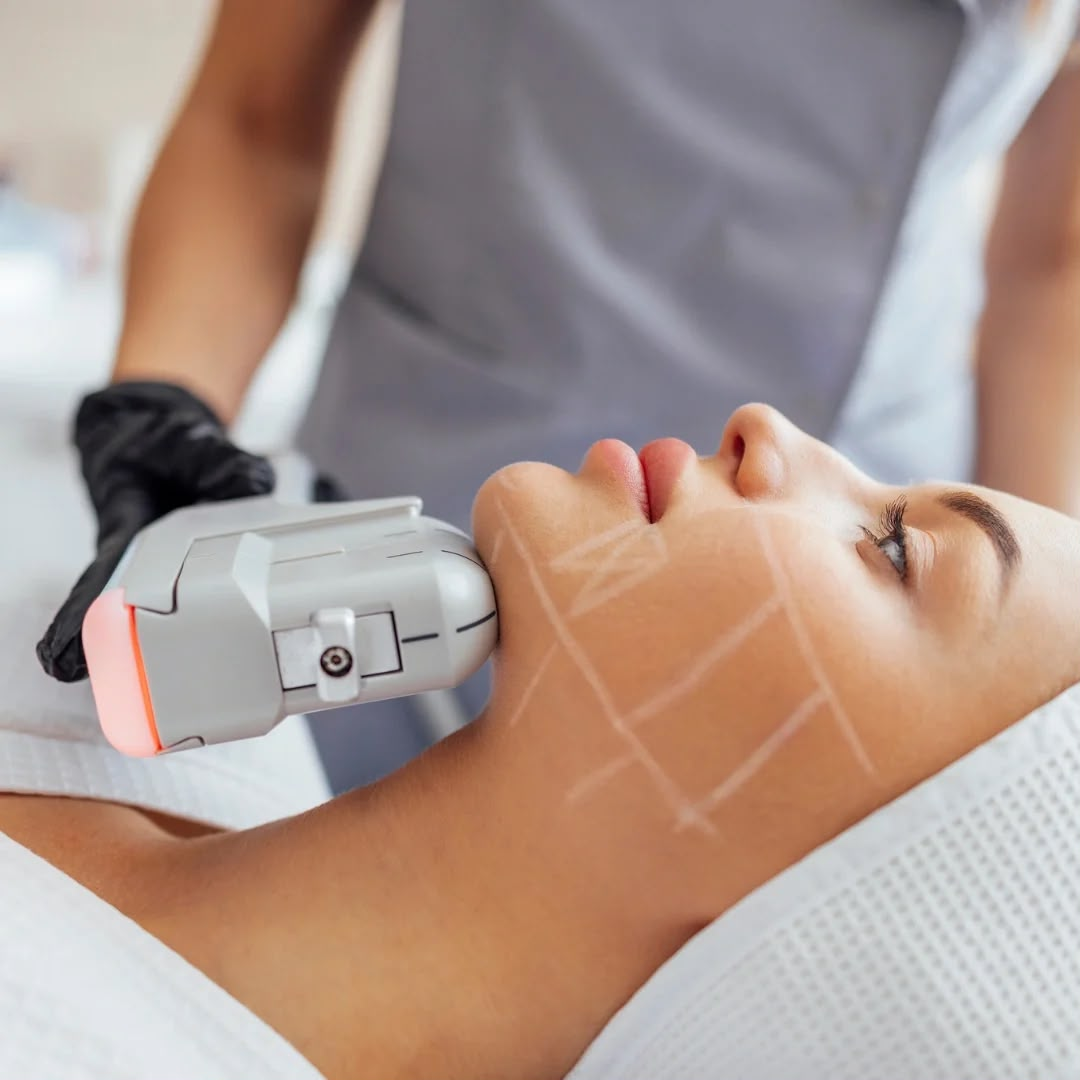 HIFU Facial + Cuello + Papada