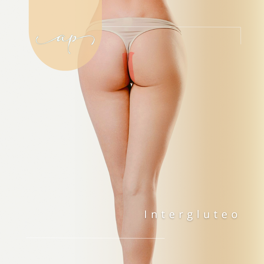 Interglúteos | Depilación Láser