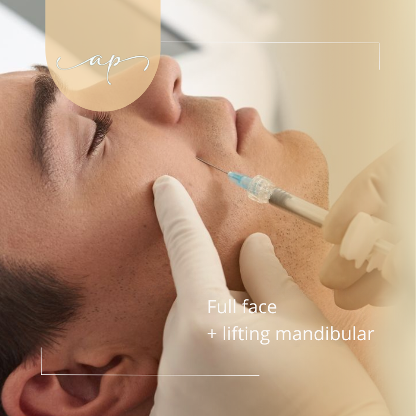 Toxina Botulínica Full Face + lifting mandibular